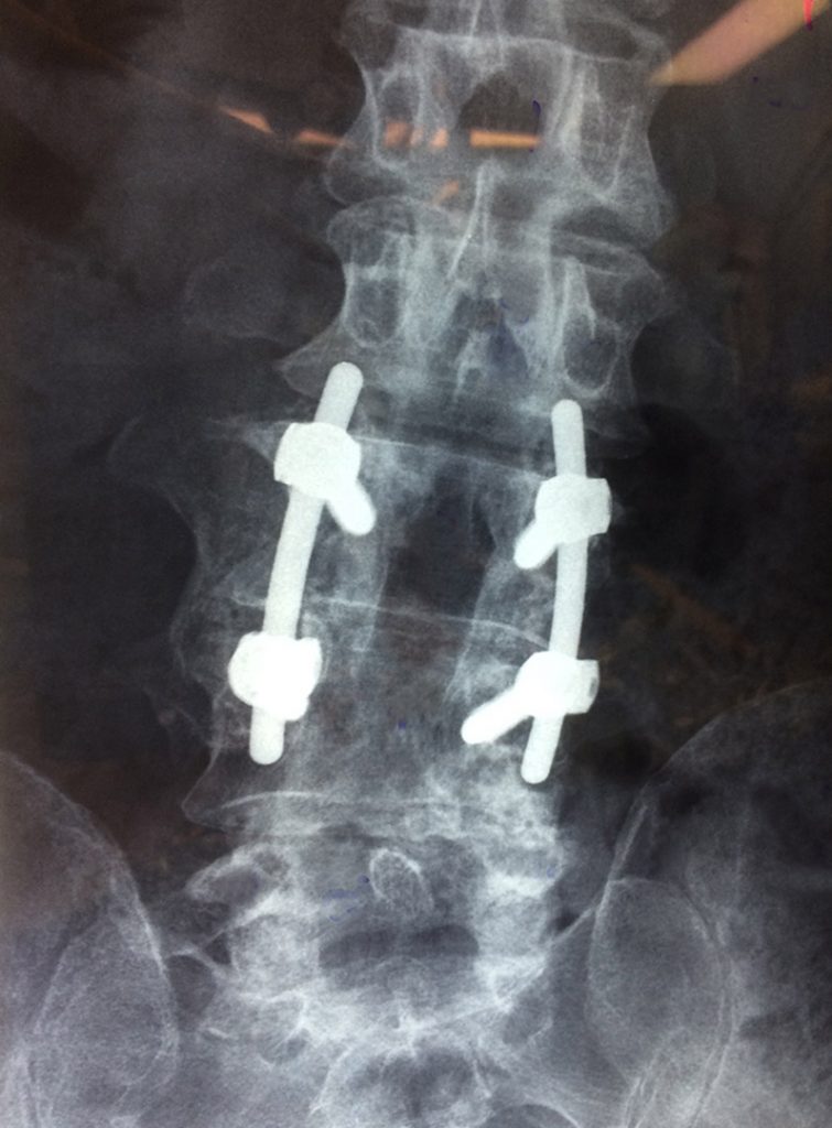 x-ray of lumbar fusion