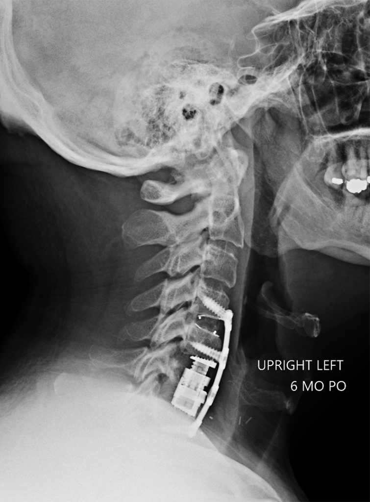 x-ray before complex cervical spine surgery