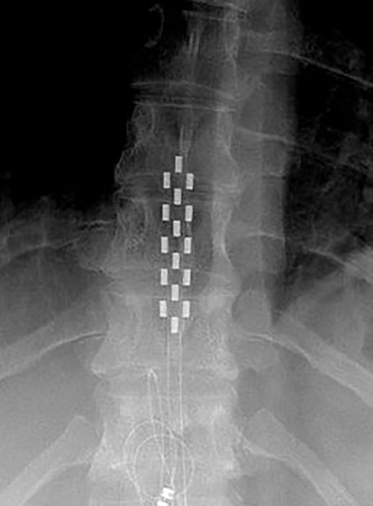 x-ray of spinal cord stimulation after procedures